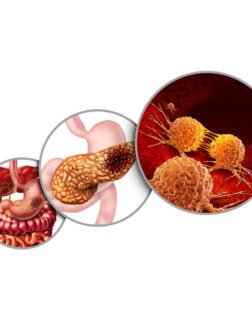 Pancreatic Cancer Treatment in Mohali