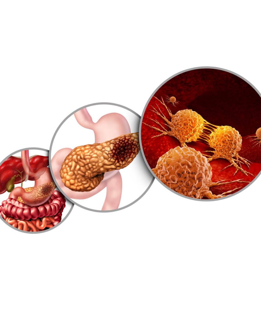 Pancreatic Cancer Treatment in Mohali