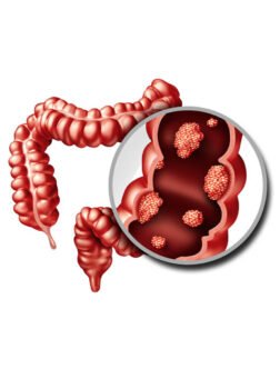 Colorectal Cancer Treatment in Mohali