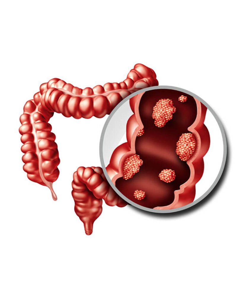 Colorectal Cancer Treatment in Mohali