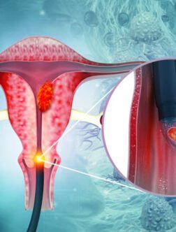 Cervical Cancer Treatment in Mohali