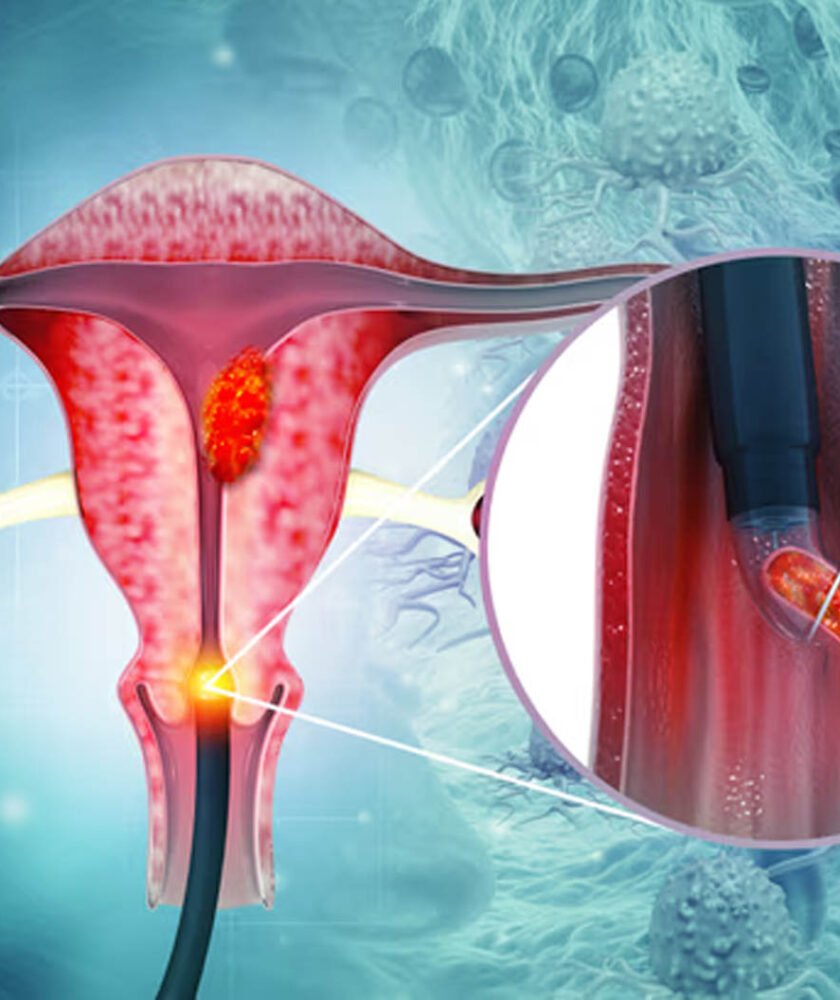 Cervical Cancer Treatment in Mohali