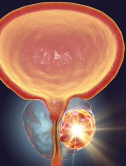 Prostate Cancer Treatment in Mohali