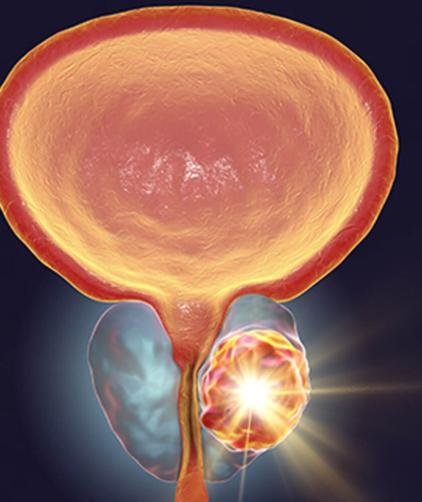 Prostate Cancer Treatment in Mohali