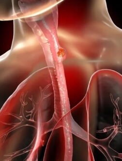 Esophageal Cancer Treatment in Mohali