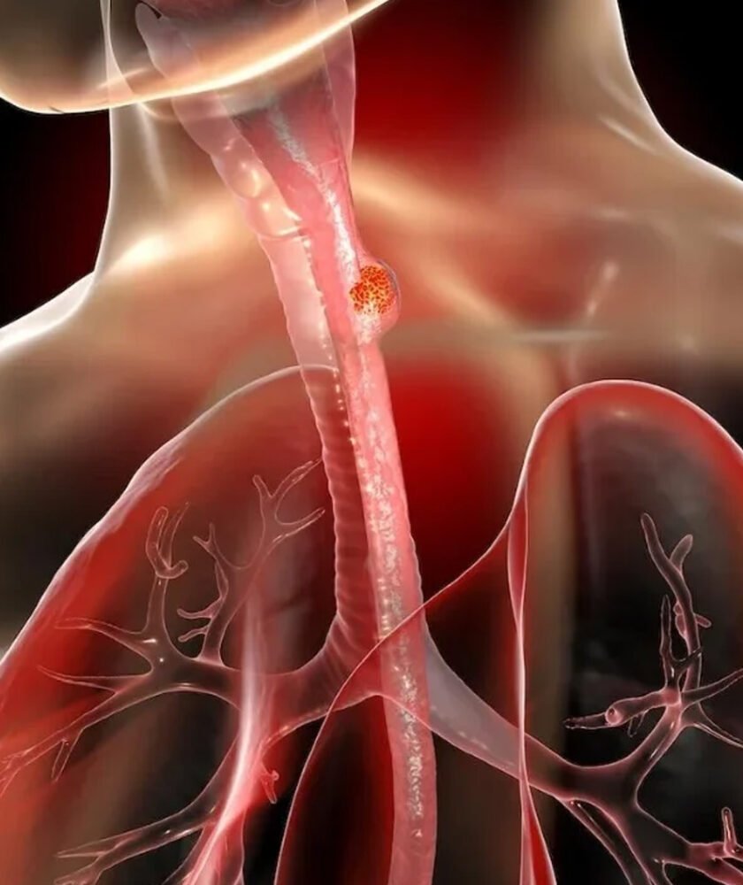 Esophageal Cancer Treatment in Mohali