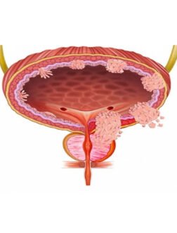 Bladder Cancer Treatment in Mohali