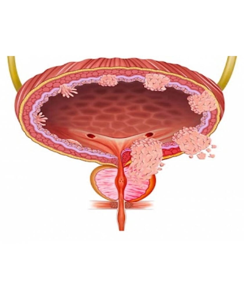 Bladder Cancer Treatment in Mohali